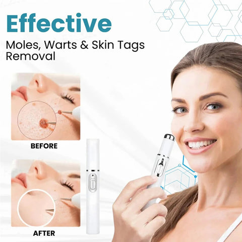 Warts Removal Laser Pen