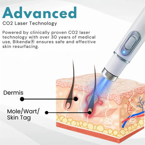 Warts Removal Laser Pen