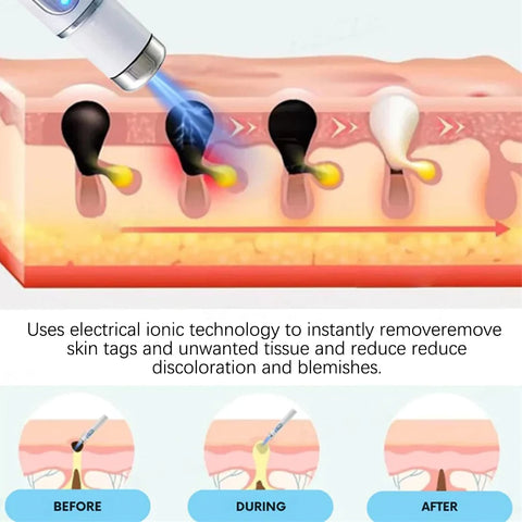 Warts Removal Laser Pen