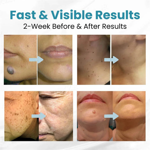 Warts Removal Laser Pen
