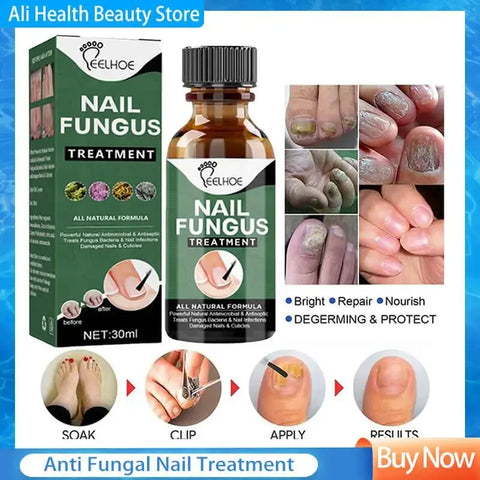Nail Fungus Serum for Nails fungal Treatment and Repair Nails
