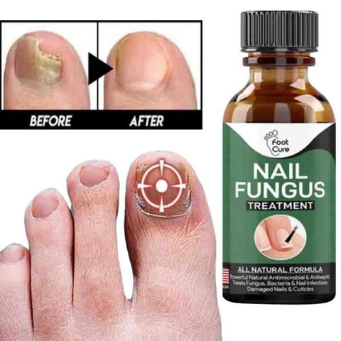 Nail Fungus Serum for Nails fungal Treatment and Repair Nails